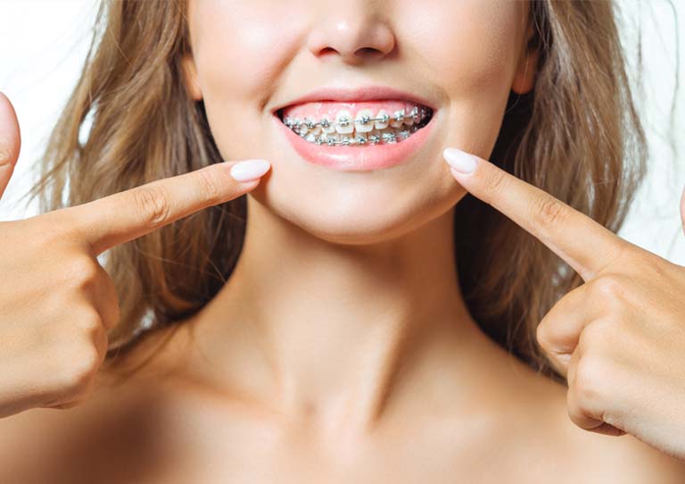 Cuidados tratamiento de ortodoncia. Ortodoncia en Avilés. Clínica Suárez Solís