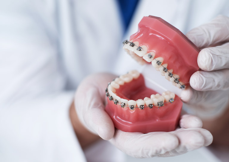 Ortodoncia acelerada o corticotomía - Ortodoncia en Avilés - Suárez Solís - Clínica dental en Avilés
