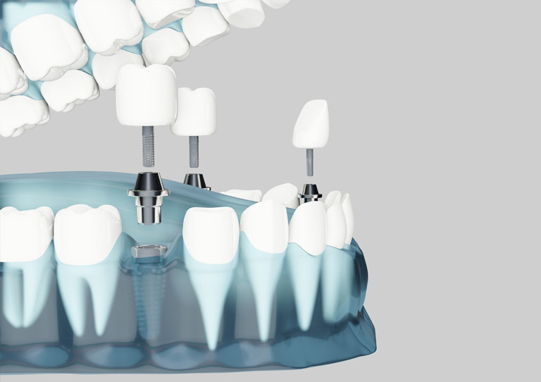 ¿Qué hacer ante dolor en un implante dental? Suárez Solís - Implantes dentales en Avilés
