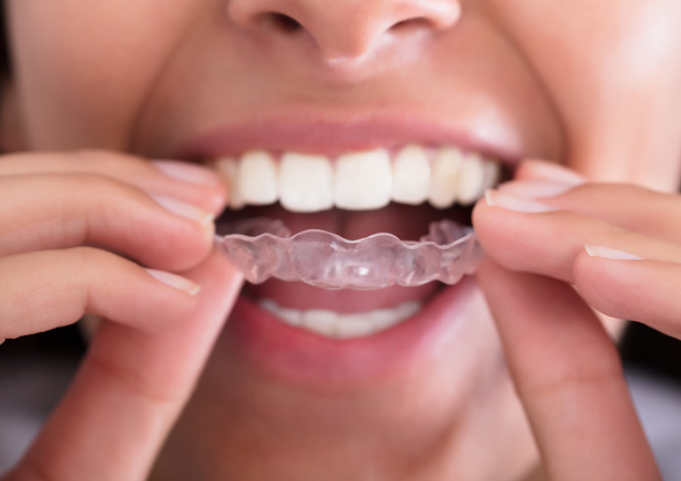 Corregir los dientes sin brackets ¡Es posible! Ortodoncia invisible en Avilés
