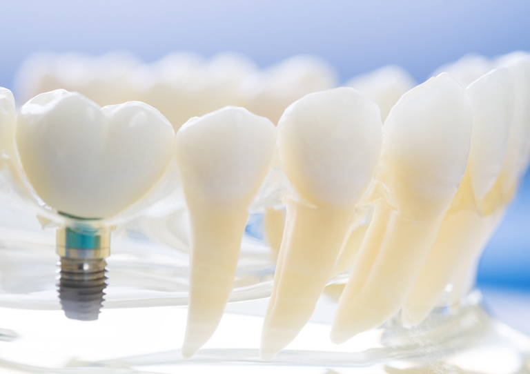 Ortodoncia multidisciplinar para rehabilitación dental -Suárez Solís - Ortodoncia en Avilés