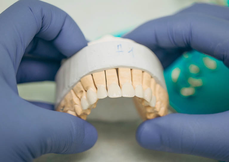 todo sobre carillas dentales.. dentistas en Avilés Suárez Solís