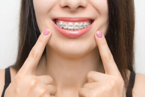 Clínica dental suarez solís. Existen muchos tipos distintos de ortodoncia para adultos