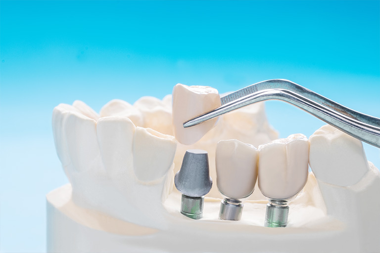 Clínica dental suarez solís. La osteointegración es una parte vital de un implante dental