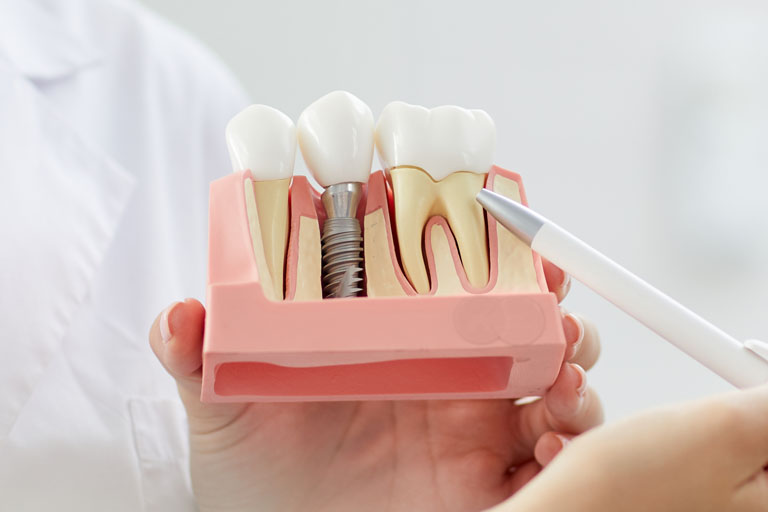 dentista en avilés explicando cómo afectan las enfermedades periodontales sobre la colocación de implantes