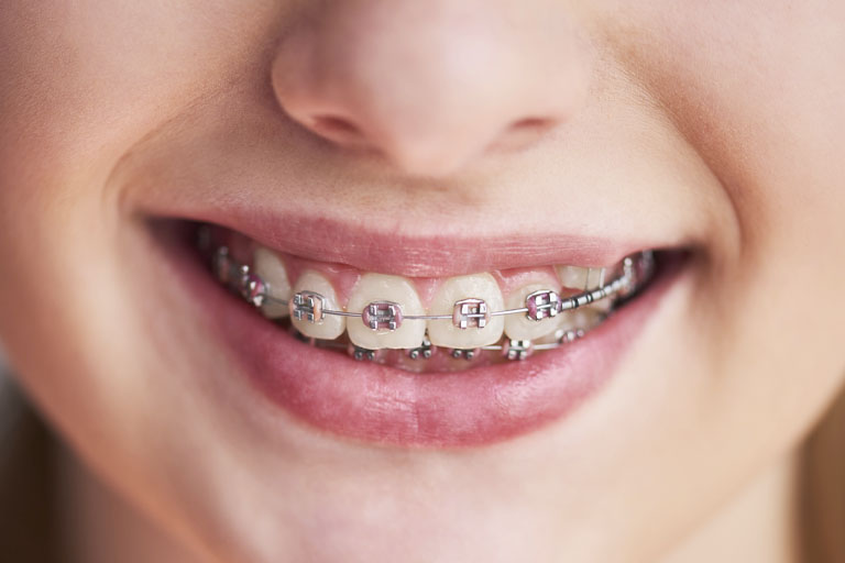 los brackets estéticos son un tipo de ortodoncia para niños muy habitual