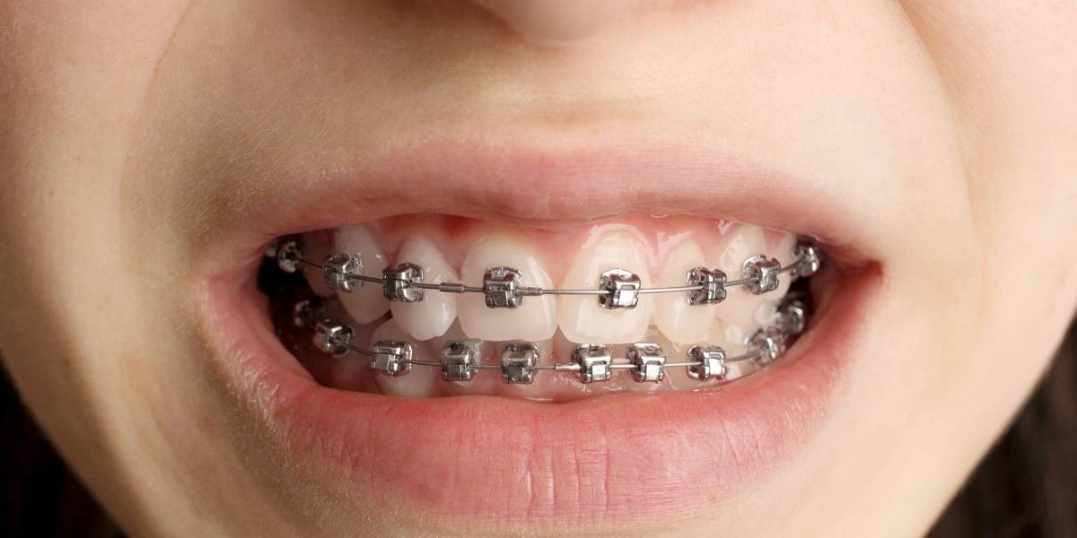 Detalle de una ortodoncia en primer plano, ilustrando la importancia de elegir alimentos adecuados para proteger y cuidar el tratamiento durante su duraciÃ³n.