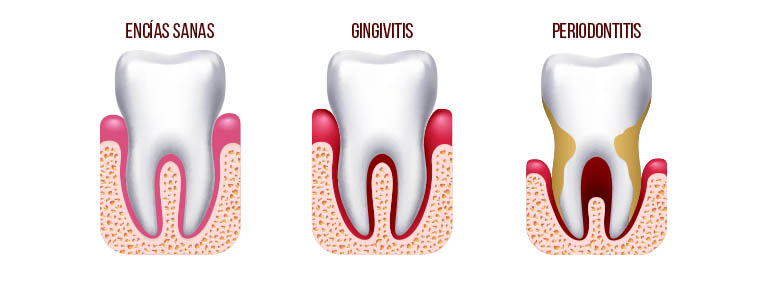 Las distintas fases de las enfermedades periodontales. Durante la Periodontitis, se pueden perder piezas dentales