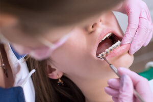 Las urgencias en ortodoncia son situaciones que trata nuestra experta en ortodoncia en Avilés, la Dra. Brezo Suárez-Solís
