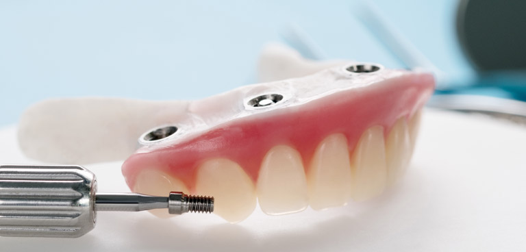 Protesis sobre implantes, la mejor alternativa a la dentadura postiza tradicional