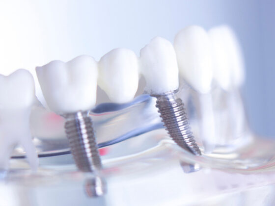Clínica Dental Suarez Solís. Muestra de restauración de dientes con implantes de carga inmediata