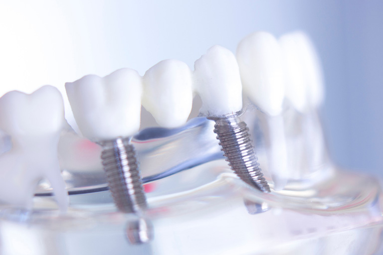 Clínica Dental Suarez Solís. Muestra de restauración de dientes con implantes de carga inmediata