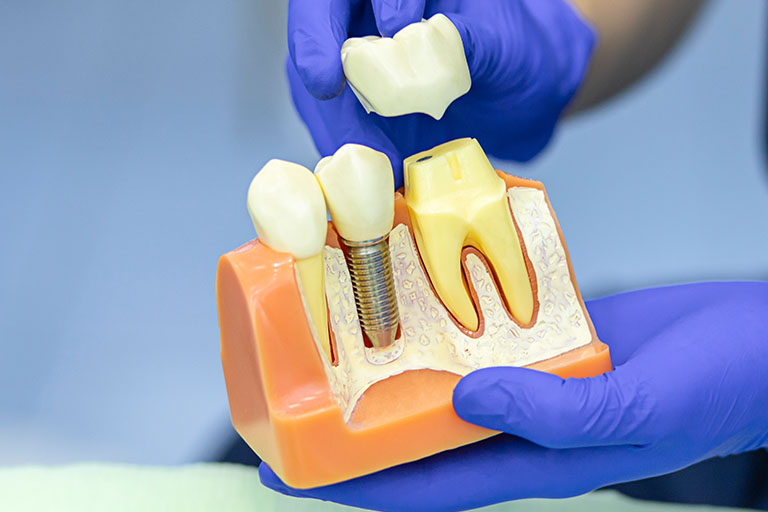 Clínica Dental Suarez Solís. ¿Eres un buen candidato para los implantes dentales? Implantes dentales en Avilés
