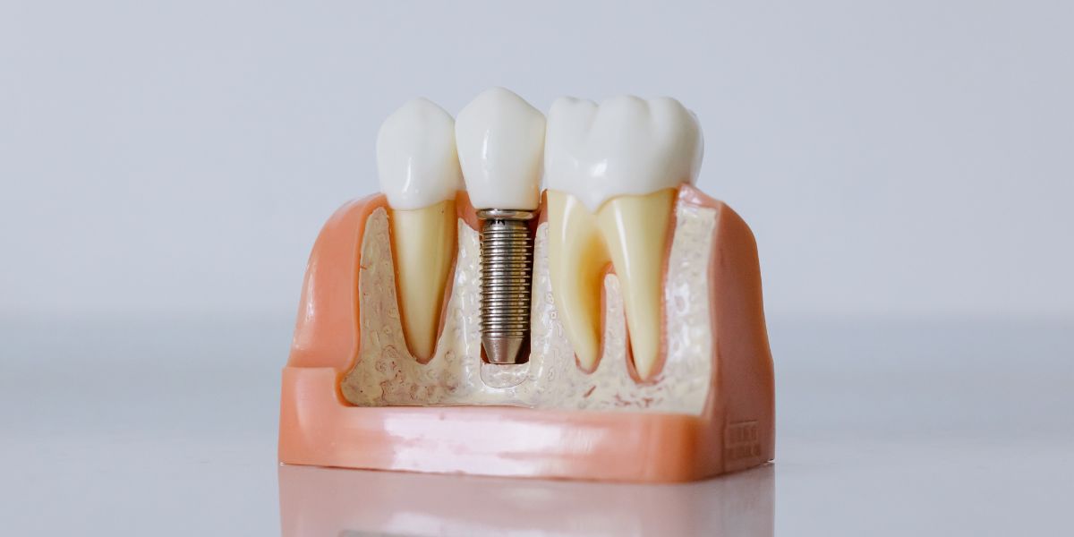 Implantes Dentales. Clínica Suárez Solís