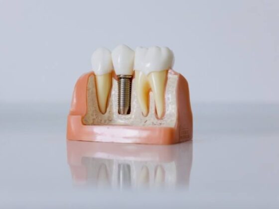 Cómo funcionan los implantes dentales
