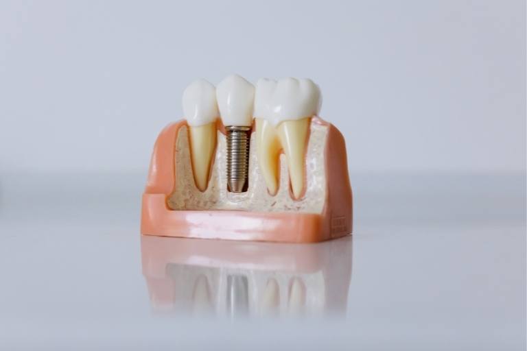 Cómo funcionan los implantes dentales