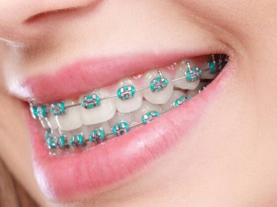 espaciadores dentales