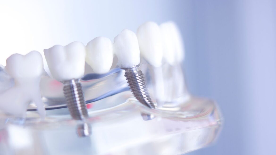 ocho paspectos que desconocías de los implantes dentales en Avilés