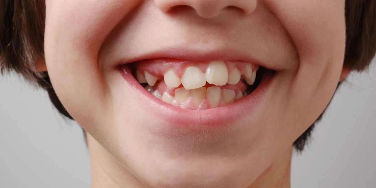 Los tratamientos tempranos de ortodoncia ofrecen una base sólida para una sonrisa saludable y alineada en el futuro, destacando la importancia de una intervención proactiva en la infancia.