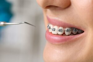 Chica joven con brackets en el dentista - Cómo afectan los brackets a las encías - Ortodoncia Avilés - Clínica Suarez SOLIS