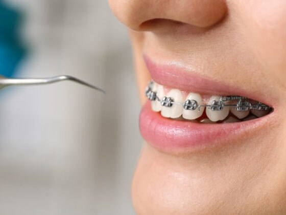 Chica joven con brackets en el dentista - Cómo afectan los brackets a las encías - Ortodoncia Avilés - Clínica Suarez SOLIS