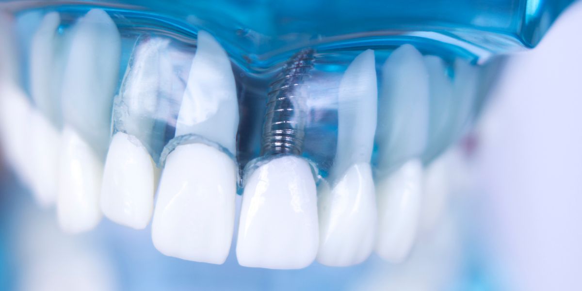 Dentadura de muestra Implante Dental - Implantes dentales para dentaduras completas - Implantes en Avilés