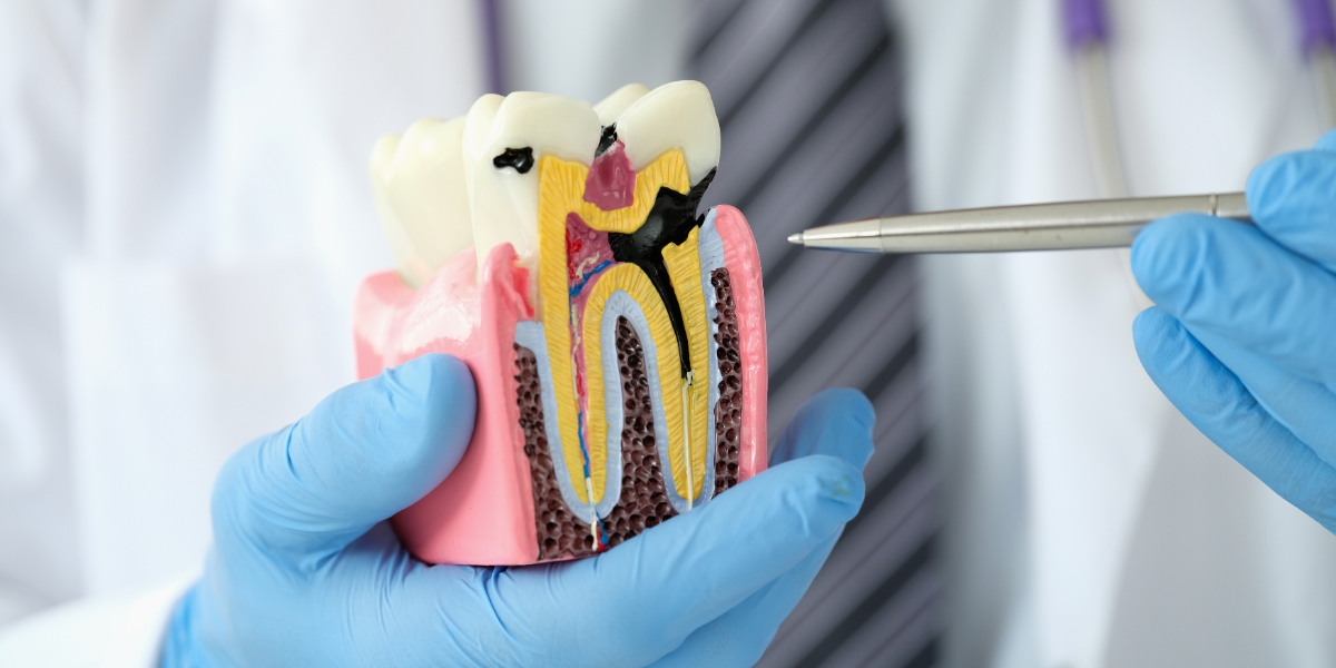Muestra de una caries Dental - Caries Interproximales - Dentista en Avilés
