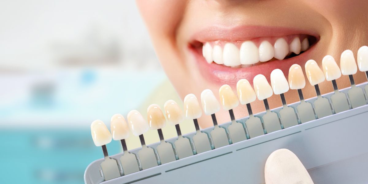 Tratamiento de carillas, selección de color que más se ajusta a la sonrisa